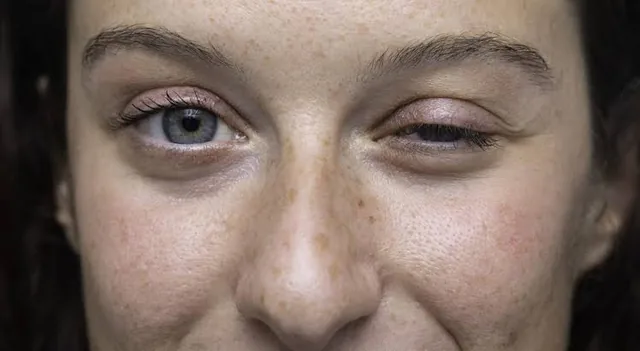 Close dos olhos de uma pessoa com queda da pálpebra, sinal comum da Miastenia Gravis